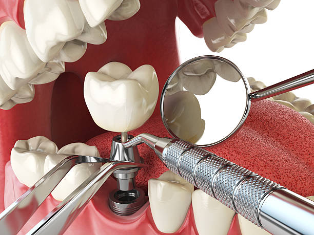 Best Emergency Dental Care for Broken or Chipped Teeth in Scotts Valley, CA