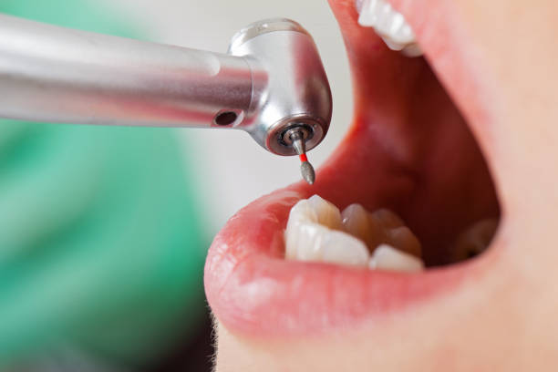Best Emergency Root Canal Treatment in Scotts Valley, CA